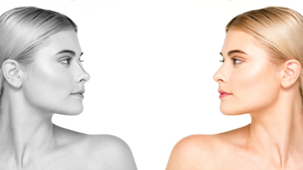 rinoplastia secundaria
