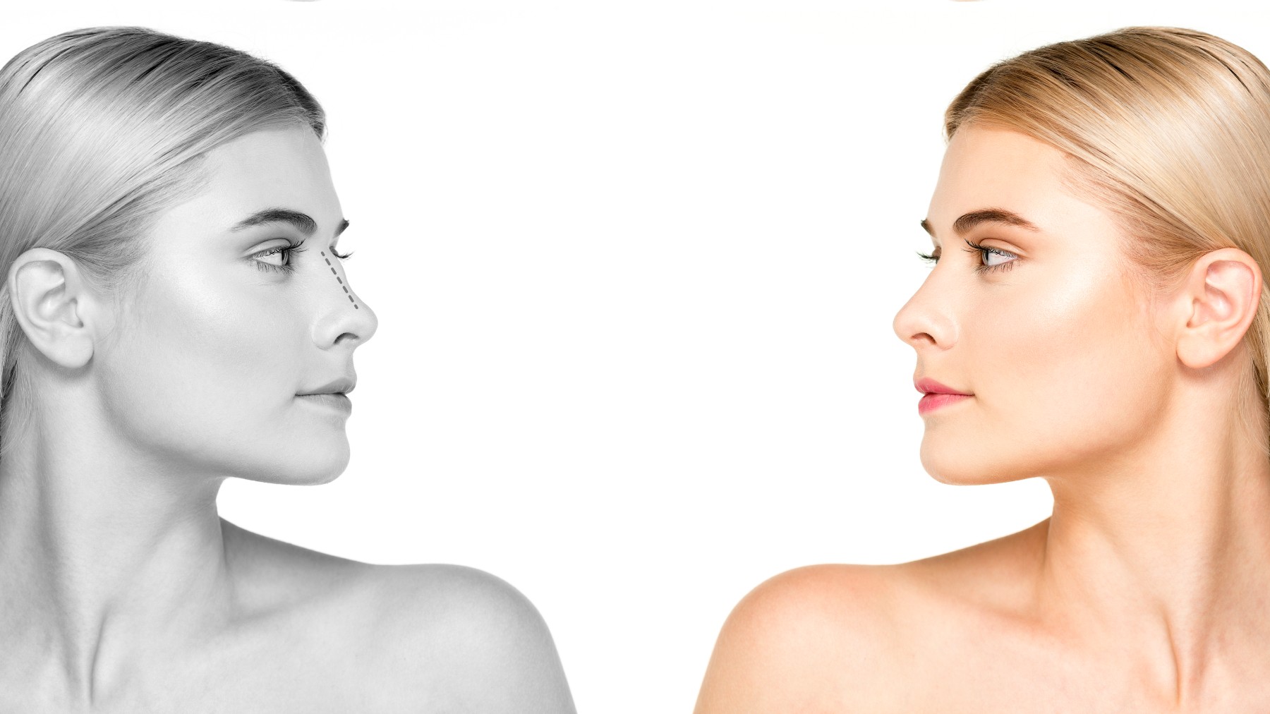 Rinoplastia secundaria ¿Qué es y en qué consiste?